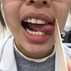 有口難言   食不下嚥-頭頸部癌症患者的嗓音及吞嚥復健(相關圖片)