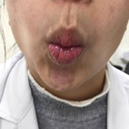 有口難言   食不下嚥-頭頸部癌症患者的嗓音及吞嚥復健(相關圖片)