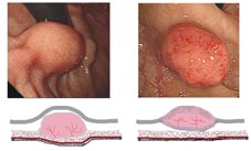 腸胃道『黏膜下腫瘤』與『膽胰疾病』的診斷與治療利器(相關圖片)