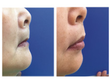 銀髮族假牙問題知多少？  (相關圖片)