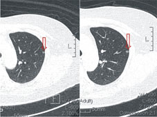  防微杜漸   談肺癌篩檢(相關圖片)