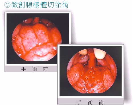 治療打鼾新進展(相關圖片)