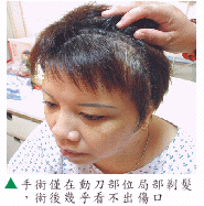 腦部大開刀不需再理光頭(相關圖片)