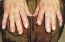 天寒地凍   淺談雷諾氏現象(相關圖片)