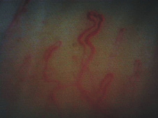 天寒地凍   淺談雷諾氏現象(相關圖片)