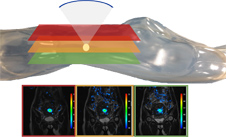 保留子宮之利器  磁振(MRI)導引海扶治療(相關圖片)