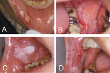 口腔內白白物體  小心是口腔黏膜疾病(相關圖片)