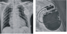 植入式心律去顫器偵測   無症狀心肌缺氧(相關圖片)