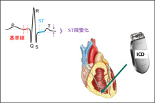 植入式心律去顫器偵測   無症狀心肌缺氧(相關圖片)