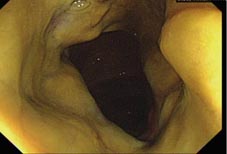 困難梭狀芽孢桿菌相關腹瀉   知多少(相關圖片)