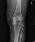 「膝」福音  引進機器人置換關節重建術(相關圖片)