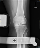 「膝」福音  引進機器人置換關節重建術(相關圖片)