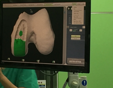 「膝」福音  引進機器人置換關節重建術(相關圖片)