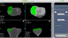 「膝」福音  引進機器人置換關節重建術(相關圖片)