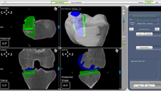 「膝」福音  引進機器人置換關節重建術(相關圖片)
