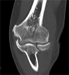治療肘關節炎  免換人工肘關節(相關圖片)