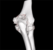 治療肘關節炎  免換人工肘關節(相關圖片)