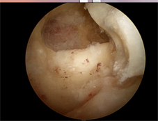 治療肘關節炎  免換人工肘關節(相關圖片)