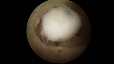 治療肘關節炎  免換人工肘關節(相關圖片)