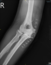 治療肘關節炎  免換人工肘關節(相關圖片)