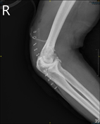 治療肘關節炎  免換人工肘關節(相關圖片)