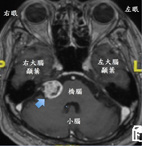 單側聽力下降小心隱形殺手    『聽神經瘤』(相關圖片)