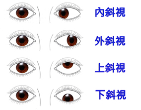 左眼右眼分道揚鑣!?   談斜視(相關圖片)