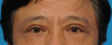 雙眸減齡美麗再現  談中老年人雙眼皮手術(相關圖片)