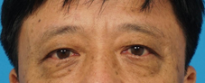 雙眸減齡美麗再現  談中老年人雙眼皮手術(相關圖片)