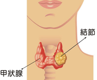 容易疏忽的甲狀腺結節疾病(相關圖片)