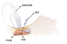 容易疏忽的甲狀腺結節疾病(相關圖片)