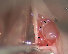 啞嗓難癒？ 恐因聲帶沾黏  談聲帶顯微皮瓣手術(相關圖片)