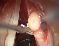 啞嗓難癒？ 恐因聲帶沾黏  談聲帶顯微皮瓣手術(相關圖片)