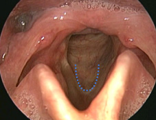 啞嗓難癒？ 恐因聲帶沾黏  談聲帶顯微皮瓣手術(相關圖片)