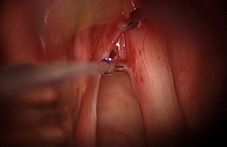 啞嗓難癒？ 恐因聲帶沾黏  談聲帶顯微皮瓣手術(相關圖片)