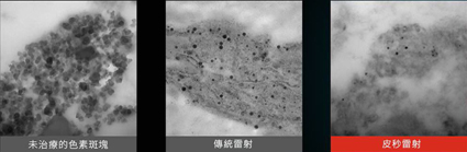 日頭赤焰焰  打雷射除斑咁好(相關圖片)