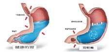 體表無傷口之『經口內視鏡幽門肌肉切開術』治療難治性胃部輕癱 (相關圖片)