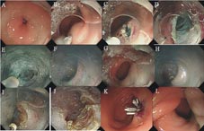 體表無傷口之『經口內視鏡幽門肌肉切開術』治療難治性胃部輕癱 (相關圖片)