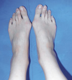 穿鞋卡卡痛痛  可能是拇趾外翻造成(相關圖片)