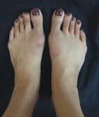 穿鞋卡卡痛痛  可能是拇趾外翻造成(相關圖片)