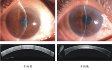 提升角膜內皮疾病恢復和視力  談角膜內皮移植手術(相關圖片)