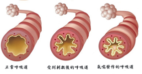 氣喘逢春易發   小兒氣喘如何預防與治療(相關圖片)