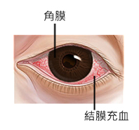 又紅又癢的兔子眼   談過敏性結膜炎(相關圖片)