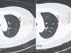 聰明就醫  談『低輻射劑量胸部電腦斷層』用於『肺癌篩檢』(相關圖片)
