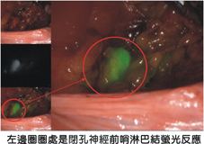 值得婦女注意的子宮內膜癌(相關圖片)