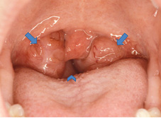 小心!打鼾竟然可能隱藏著猝死的風險   談打鼾合併睡眠呼吸中止症(相關圖片)