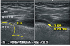 穿衣、睡覺時肩膀好痛怎麼辦？  談肩痛的有效治療(相關圖片)