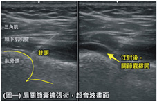 穿衣、睡覺時肩膀好痛怎麼辦？  談肩痛的有效治療(相關圖片)