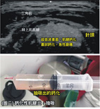 穿衣、睡覺時肩膀好痛怎麼辦？  談肩痛的有效治療(相關圖片)