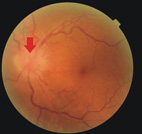 啥米，視神經也會中風?!(相關圖片)